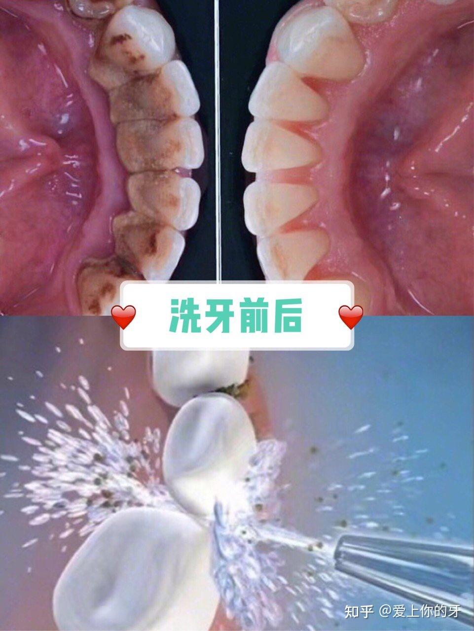 永州洗牙可以用医保吗(洗牙可以用医保吗,报销比例多少)